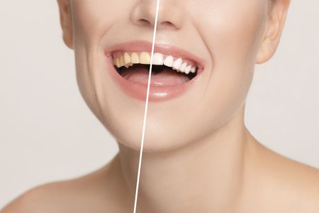 Smart toothbrush results showing a split image of teeth before & after whitening, with a bright smile