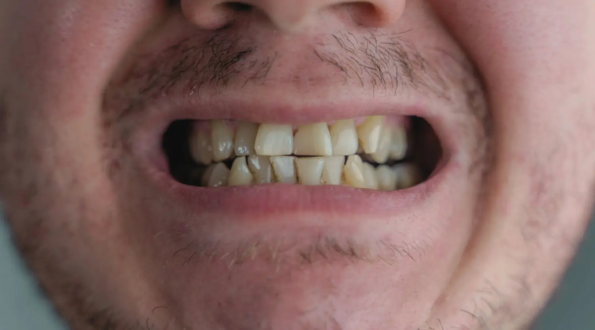 Close-up of an adult mouth showing crowded, shifted teeth and visible misalignment.