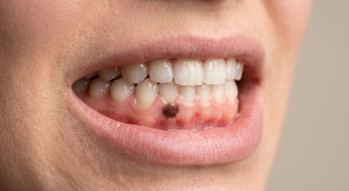 Close-up of a dark pigmented spot on the lower gum near front teeth.