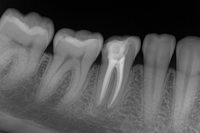 Why Antibiotics Can't Replace Root Canals: What Every Patient Needs to Know