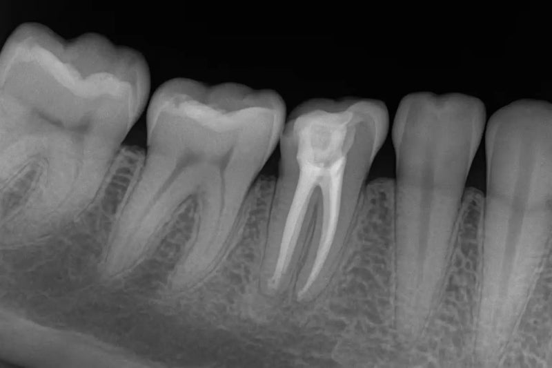 Why Antibiotics Can't Replace Root Canals: What Every Patient Needs to Know