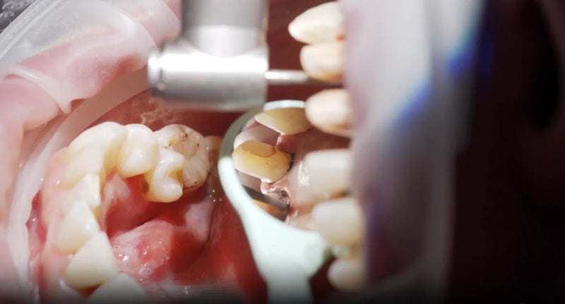 How to Tell if You Have Gingivitis or Periodontitis: 12 Warning Signs of Gum Disease