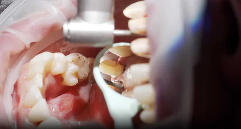 How to Tell if You Have Gingivitis or Periodontitis: 12 Warning Signs of Gum Disease
