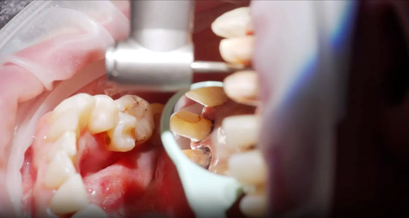 Close-up dental exam showing receding gums and inflamed tissue around molars with a mouth mirror.
