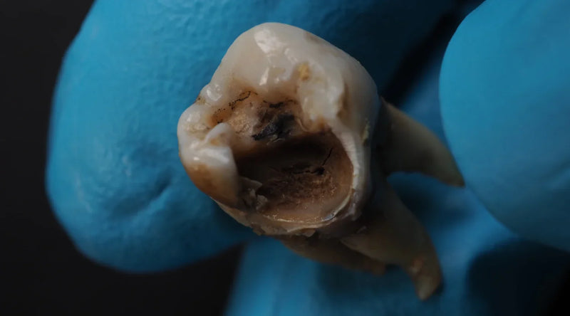 Gloved hand holding an extracted molar showing severe tooth decay and a dark cavity inside.