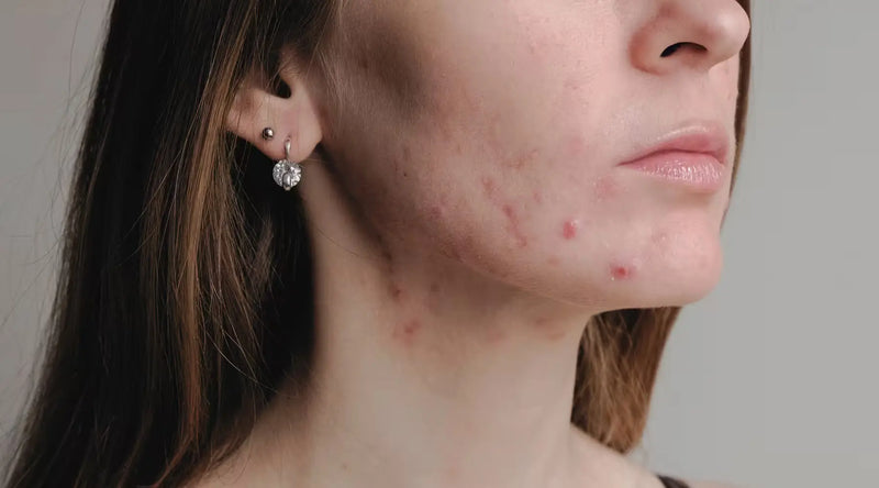 Close-up of a person's lower face and neck showing red acne breakouts along the jawline.