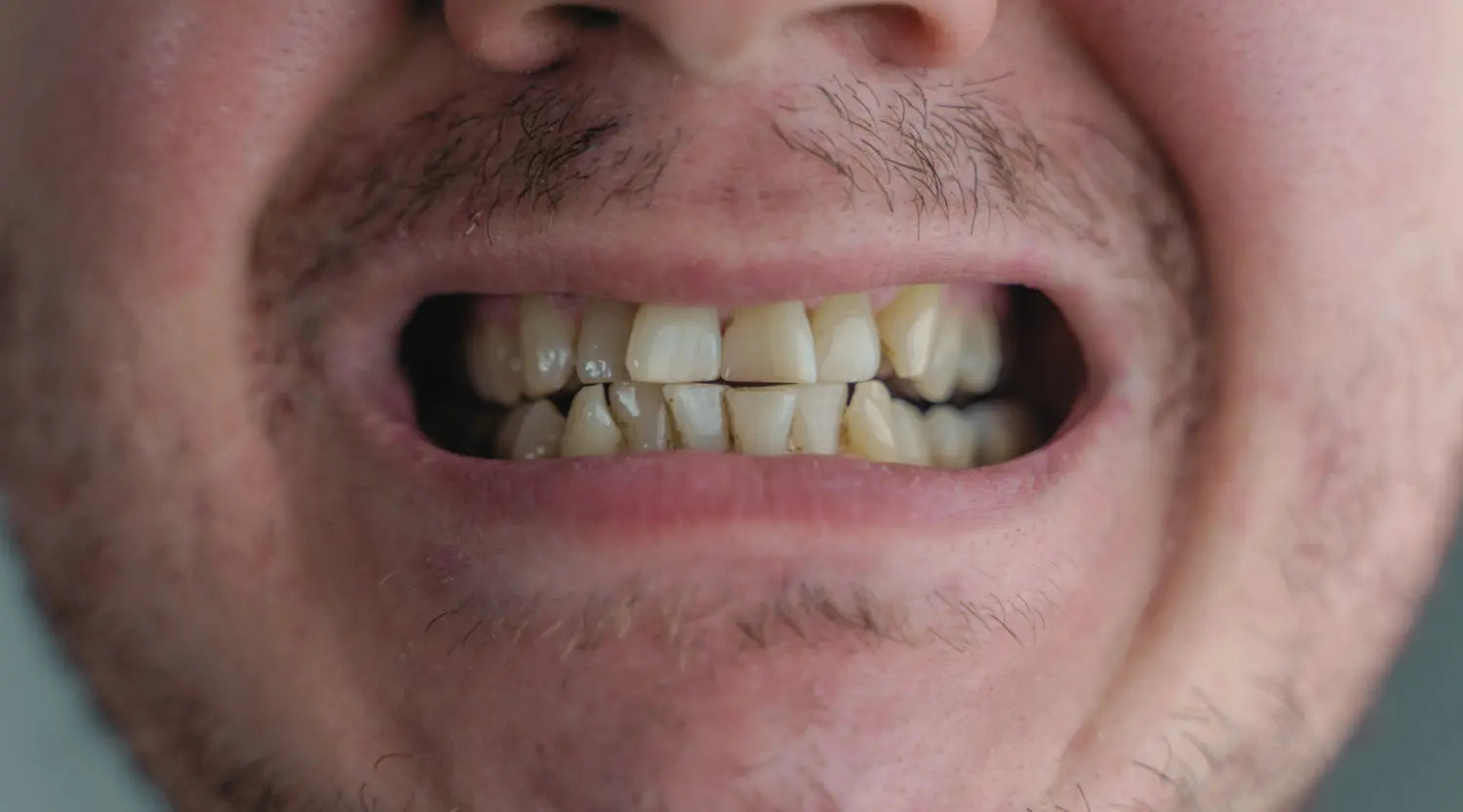 Adult Teeth Shifting Leads To These 5 Serious Health Problems