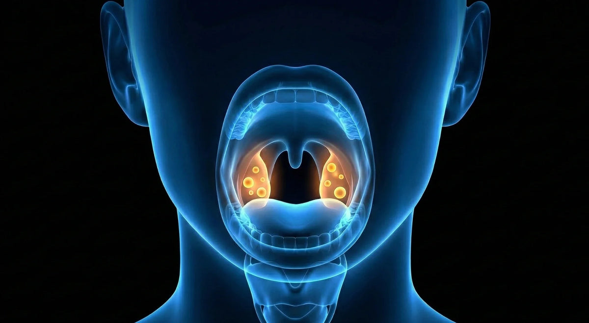X-ray-style illustration of an open mouth showing tonsil stones in inflamed tonsils.