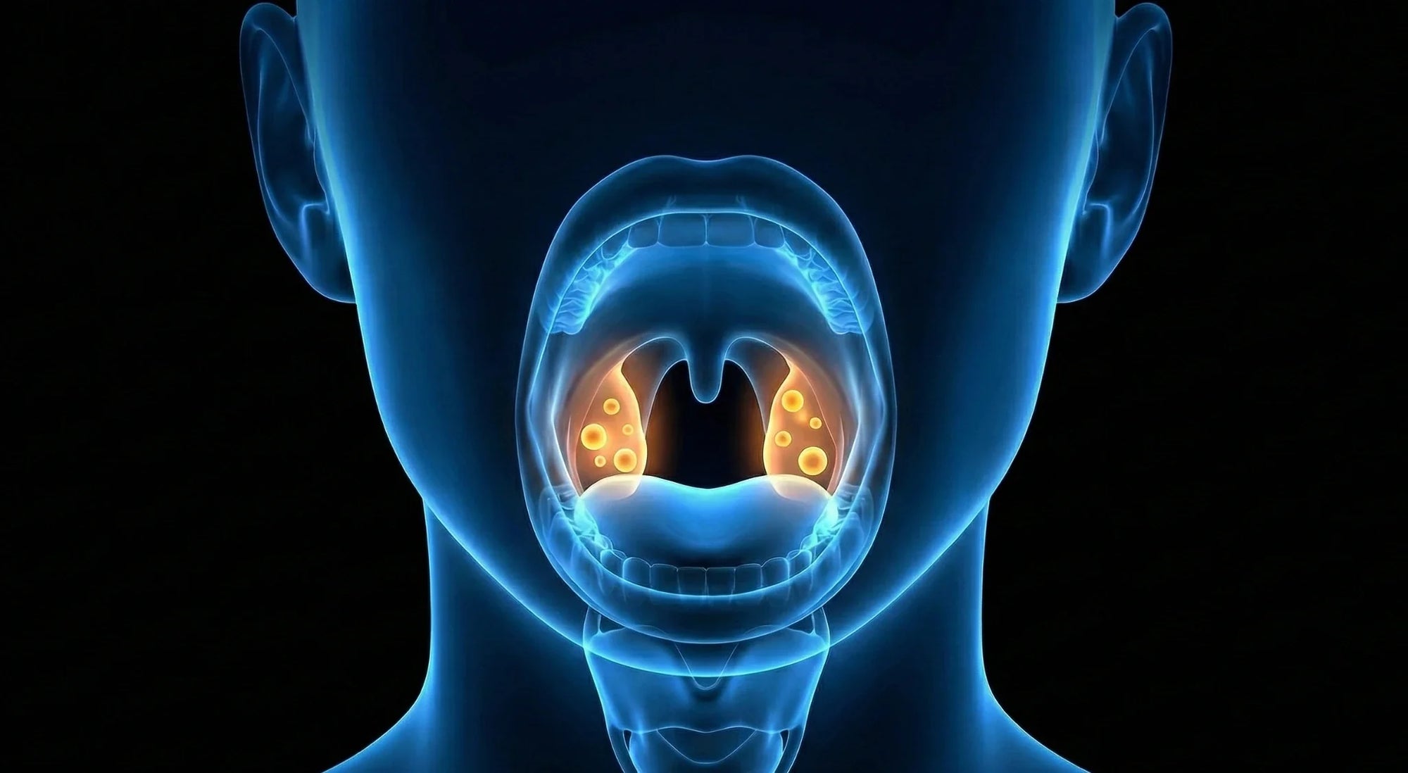 Tonsil Stones: What Causes Them and How to Prevent Recurrence
