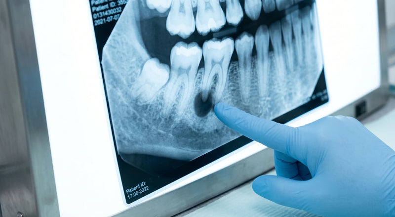 The Tooth Infection That Quietly Threatens Your Heart