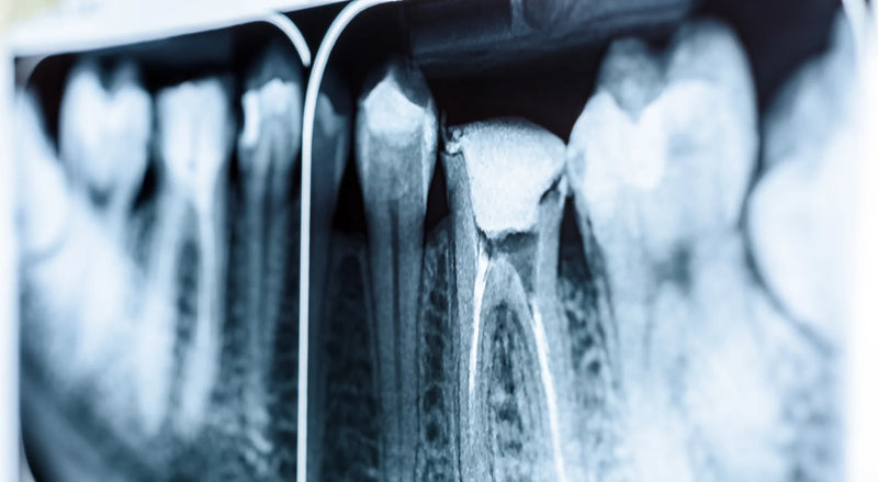 Can an Unfinished Root Canal Cause Serious Symptoms?