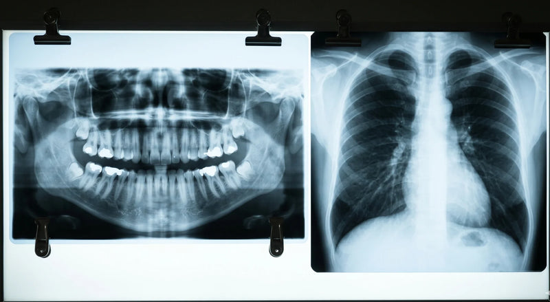 What Childhood Cavities Could Mean for Your Heart Later in Life